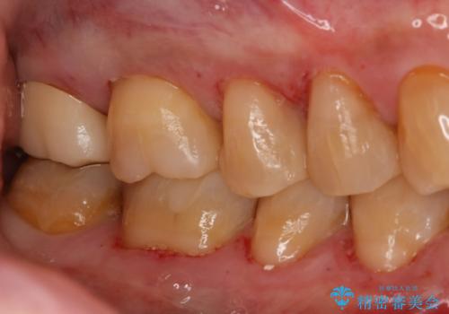 銀歯からセラミックへの症例 治療後