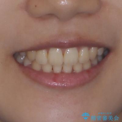 急速拡大装置 狭い骨幅を拡大した上で、口元の突出感を改善する抜歯矯正治療の治療後(顔貌)