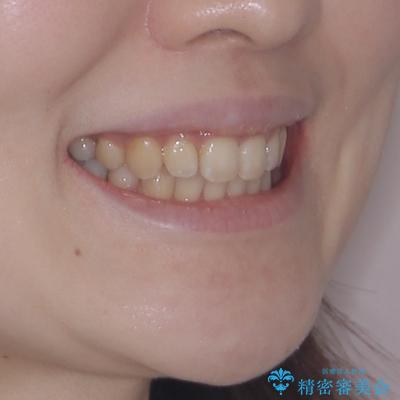 出っ歯を治したい ワイヤー装置での抜歯矯正の治療後(顔貌)