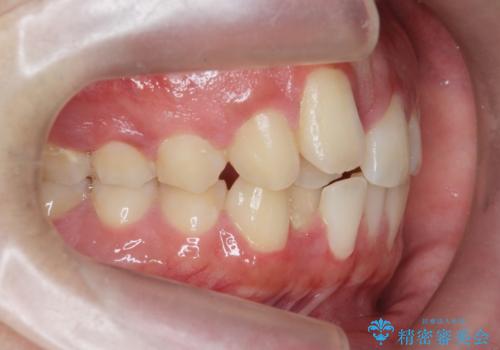 正中過剰埋伏歯で生じた前歯の審美障害 矯正治療での改善の治療前