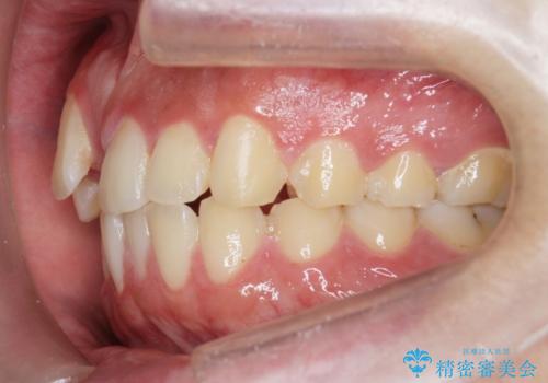 正中過剰埋伏歯で生じた前歯の審美障害 矯正治療での改善の治療前