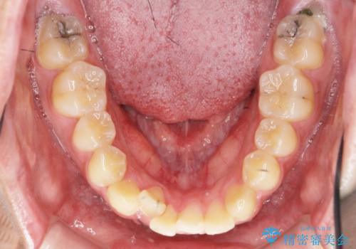 正中過剰埋伏歯で生じた前歯の審美障害 矯正治療での改善の治療前