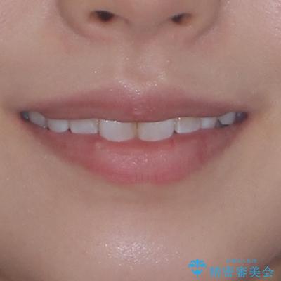 マウスピースが面倒くさい インビザラインでできるところまで頑張った矯正治療の治療後(顔貌)