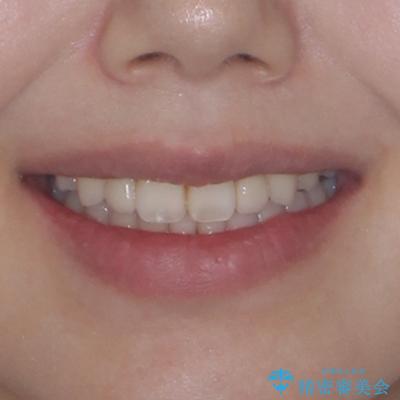 飛び出した前歯 インビザラインを用いた抜歯矯正治療の治療後(顔貌)