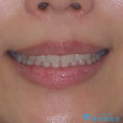 補助装置を併用して確実に インビザラインで奥歯の咬み合わせをしっかりと改善の治療後(顔貌)