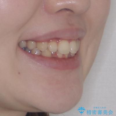 出っ歯を治したい ワイヤー装置での抜歯矯正の治療前(顔貌)