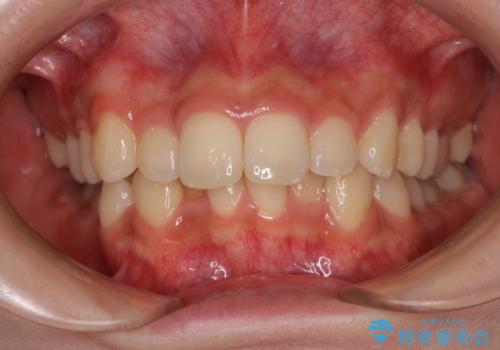出っ歯を治したい ワイヤー装置での抜歯矯正の症例 治療前