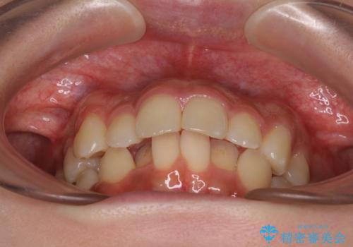 出っ歯を治したい ワイヤー装置での抜歯矯正の治療前