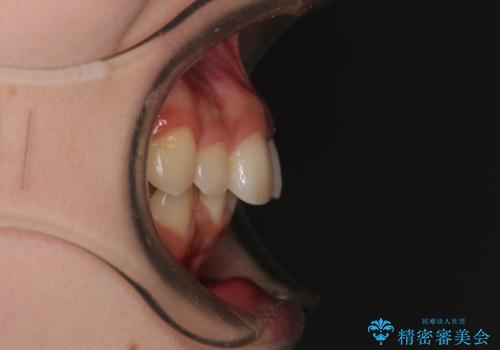 出っ歯を治したい ワイヤー装置での抜歯矯正の治療前