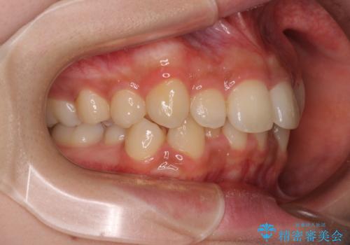 出っ歯を治したい ワイヤー装置での抜歯矯正の治療前