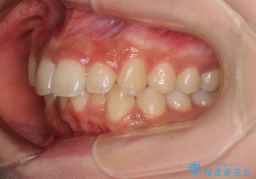 出っ歯を治したい ワイヤー装置での抜歯矯正の治療前