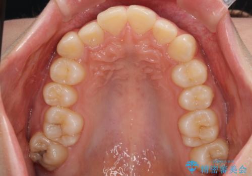 出っ歯を治したい　ワイヤー装置での抜歯矯正の治療前