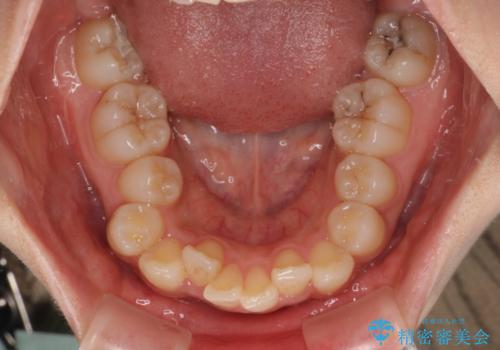 出っ歯を治したい ワイヤー装置での抜歯矯正の治療前
