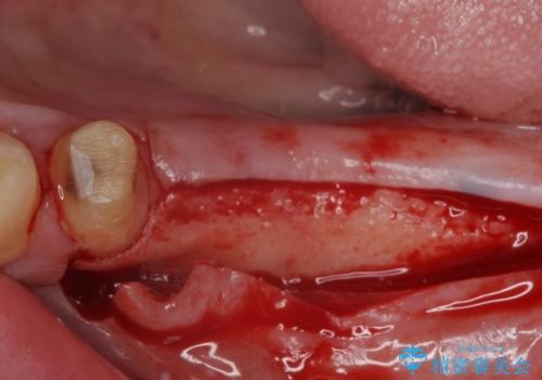 欠損の多い奥歯 インプラントによる補綴治療の治療前