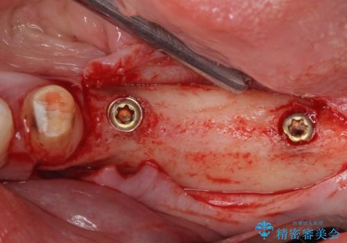 欠損の多い奥歯 インプラントによる補綴治療の治療中