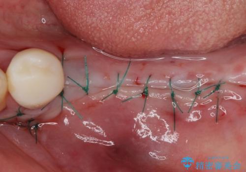 欠損の多い奥歯 インプラントによる補綴治療の治療後