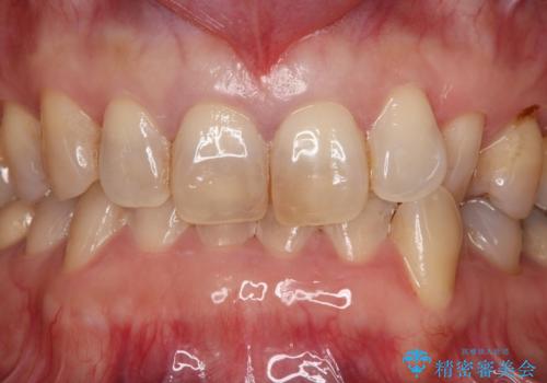 前歯の色が気になる オールセラミッククラウンで綺麗で健康な歯にの治療前