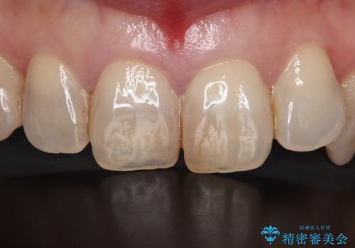前歯の色が気になる オールセラミッククラウンで綺麗で健康な歯にの症例 治療前