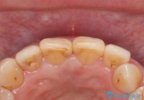 前歯の色が気になる　オールセラミッククラウンで綺麗で健康な歯にの治療前