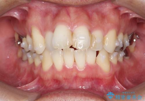矯正と虫歯のセラミック治療 総合歯科治療の実践の治療中