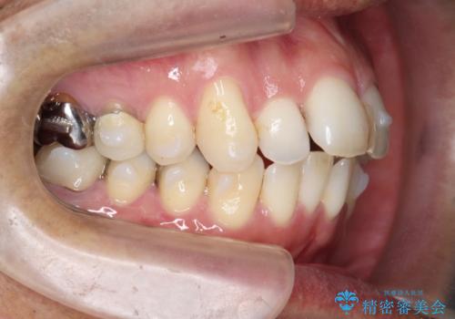 矯正と虫歯のセラミック治療 総合歯科治療の実践の治療中