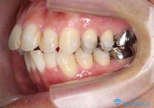 矯正と虫歯のセラミック治療 総合歯科治療の実践の治療中