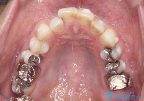 矯正と虫歯のセラミック治療 総合歯科治療の実践の治療中