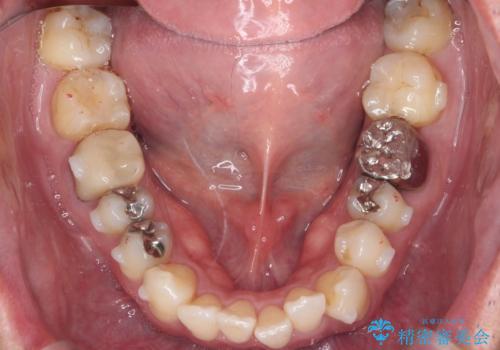 矯正と虫歯のセラミック治療 総合歯科治療の実践の治療中