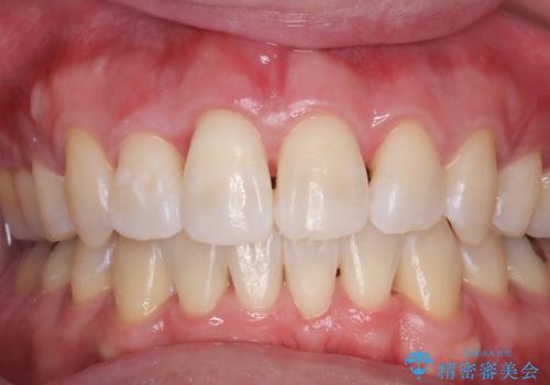 白い歯で、第一印象アップ