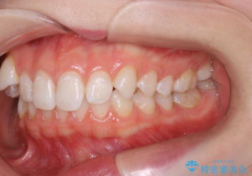 八重歯と歯のズレを解消し、整った笑顔への治療前