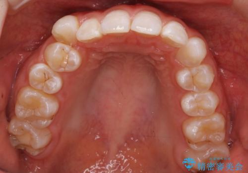 八重歯と歯のズレを解消し、整った笑顔への治療前