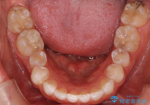 八重歯と歯のズレを解消し、整った笑顔への治療前