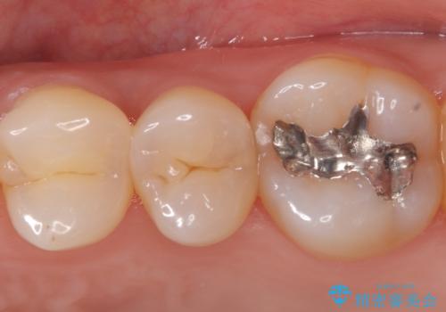 虫歯の治療 〈セラミックインレー〉の症例 治療前