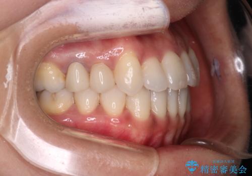 【審美装置】抜歯の本数最小限で行った矯正治療の治療後