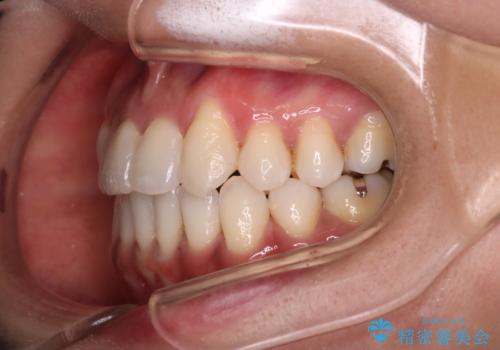 【審美装置】抜歯の本数最小限で行った矯正治療の治療後