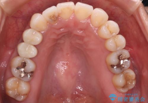 【審美装置】抜歯の本数最小限で行った矯正治療の治療後