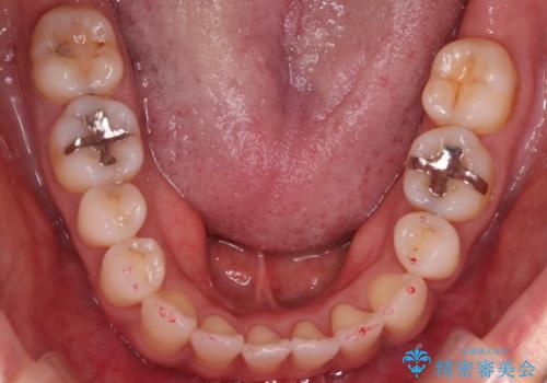 【審美装置】抜歯の本数最小限で行った矯正治療の治療後