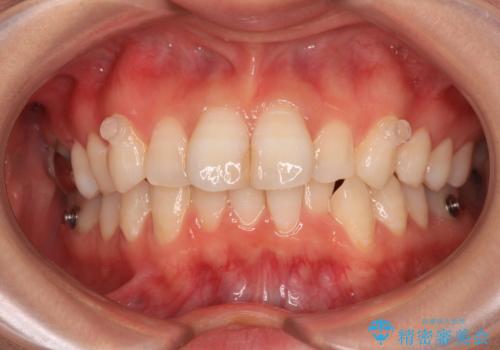 マウスピースが面倒くさい インビザラインでできるところまで頑張った矯正治療の治療中