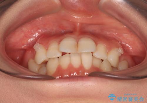 マウスピースが面倒くさい インビザラインでできるところまで頑張った矯正治療の治療中