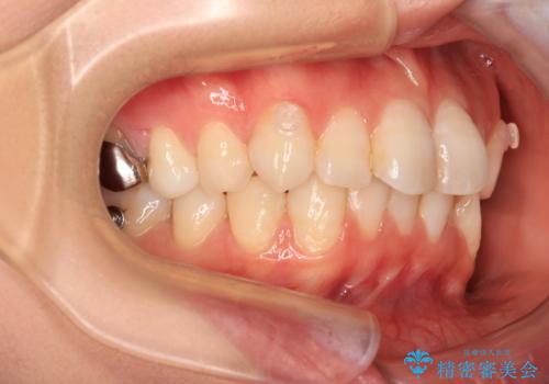 マウスピースが面倒くさい インビザラインでできるところまで頑張った矯正治療の治療中