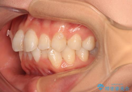 マウスピースが面倒くさい インビザラインでできるところまで頑張った矯正治療の治療中