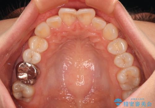マウスピースが面倒くさい インビザラインでできるところまで頑張った矯正治療の治療中