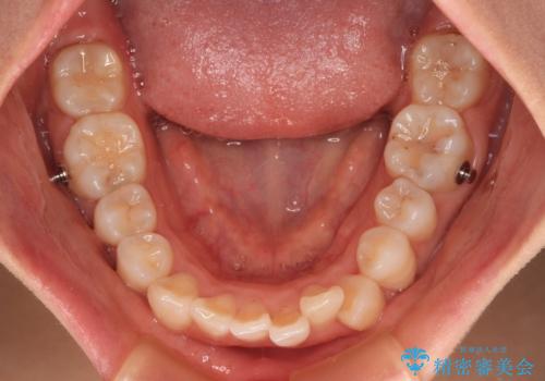 マウスピースが面倒くさい インビザラインでできるところまで頑張った矯正治療の治療中