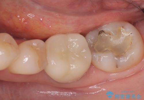 銀歯が取れた 〈セラミックインレー〉の症例 治療前