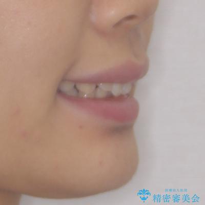 上の前歯が下唇に引っかかる 口元を引っ込めすぎない抜歯矯正治療の治療前(顔貌)