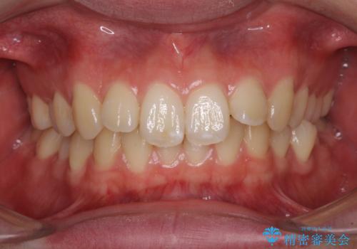 上の前歯が下唇に引っかかる 口元を引っ込めすぎない抜歯矯正治療の症例 治療前
