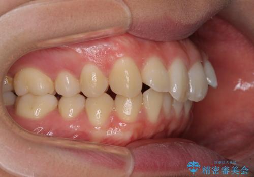 上の前歯が下唇に引っかかる 口元を引っ込めすぎない抜歯矯正治療の治療前