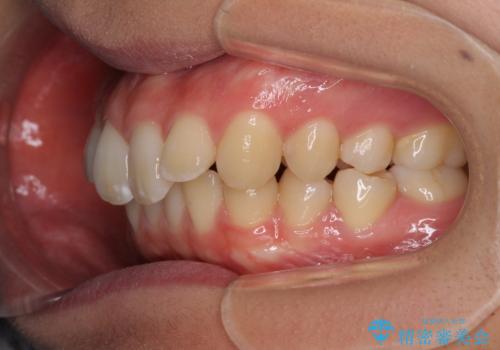 上の前歯が下唇に引っかかる 口元を引っ込めすぎない抜歯矯正治療の治療前