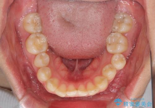 上の前歯が下唇に引っかかる 口元を引っ込めすぎない抜歯矯正治療の治療前