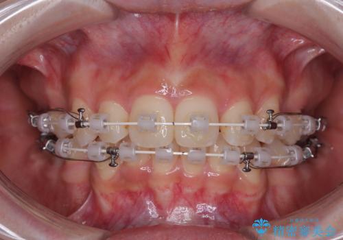 出っ歯を治したい ワイヤー装置での抜歯矯正の治療中